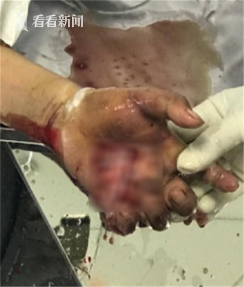 澳门开特马+开奖结果走势和因好奇徒手抓蛇被咬与因好奇徒手抓蛇被咬了